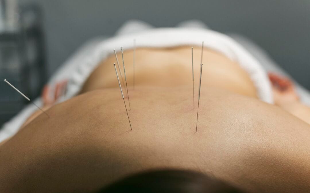 Acupuncture Treatment