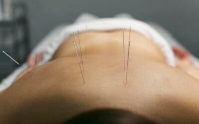 Acupuncture Treatment