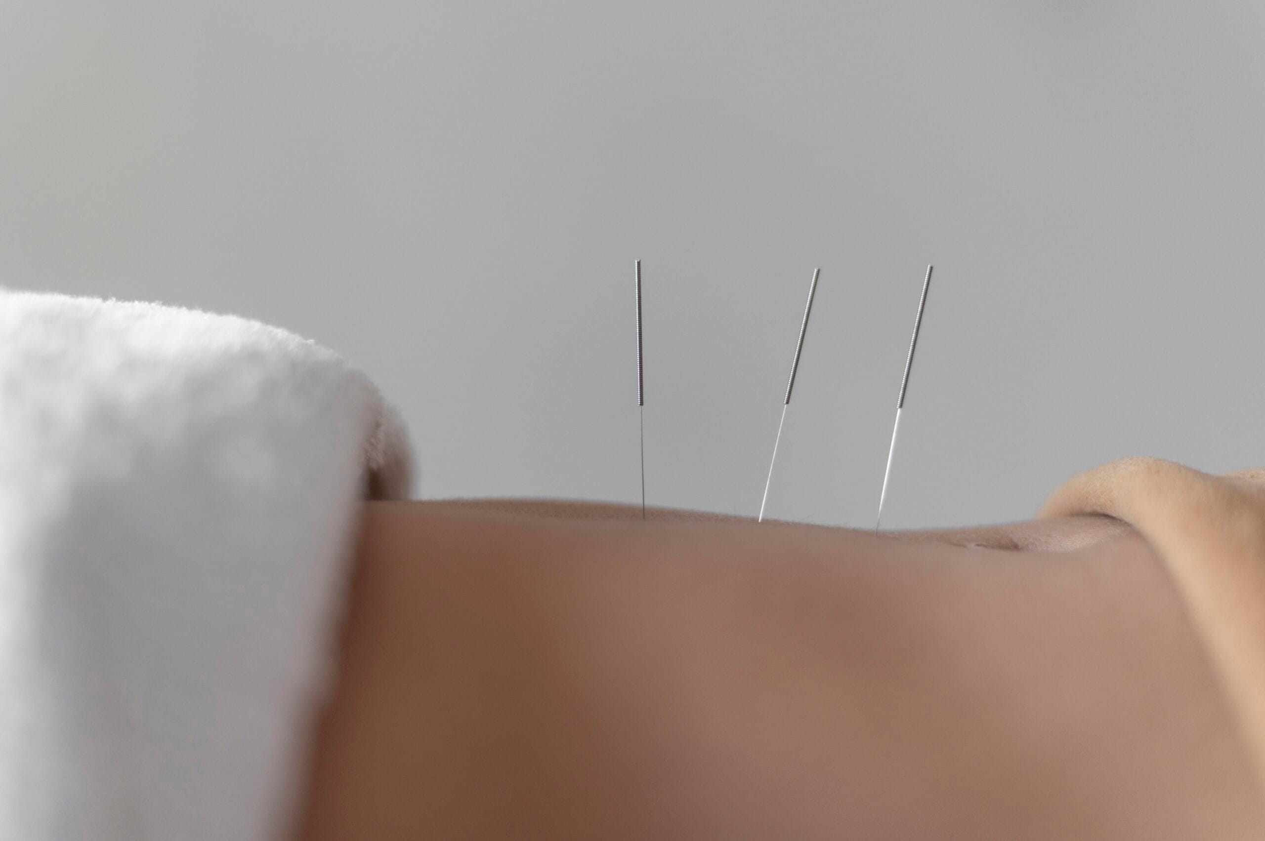 Acupuncture session for pain relief at number1thaimassage.co.uk Newcastle City Centre