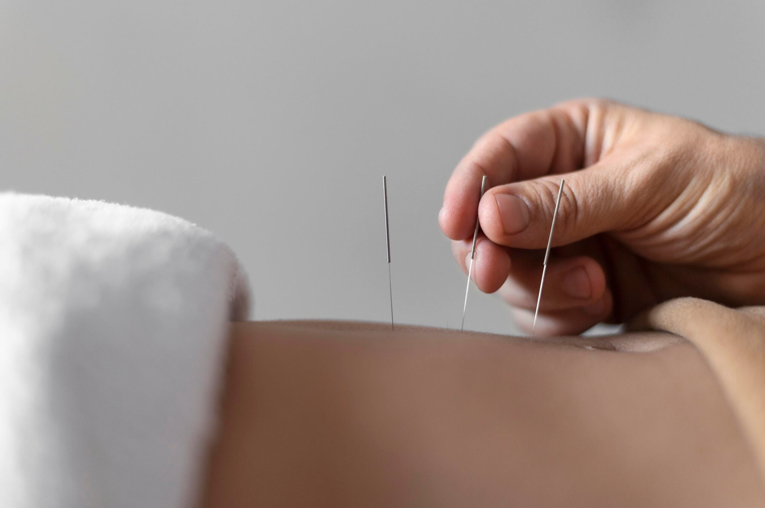 Close-up of acupuncture needles for fertility treatment in Newcastle City Centre