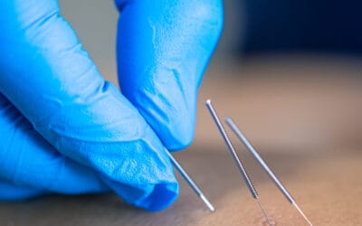 Acupuncture Treatment